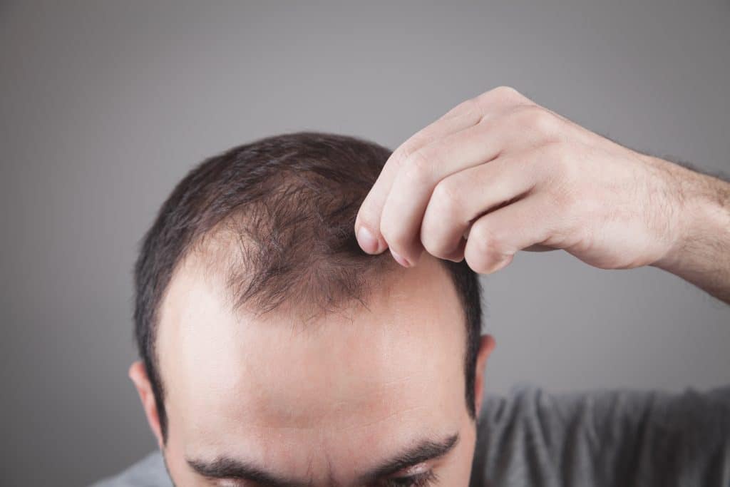 Caucasian man checking his hair. Hair loss problem